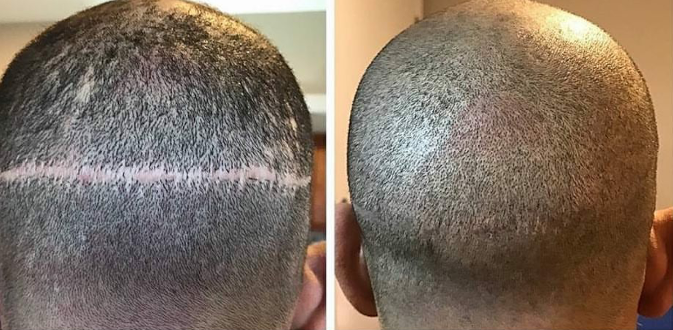 Conoce la Técnica FUSS Vs Técnica FUE