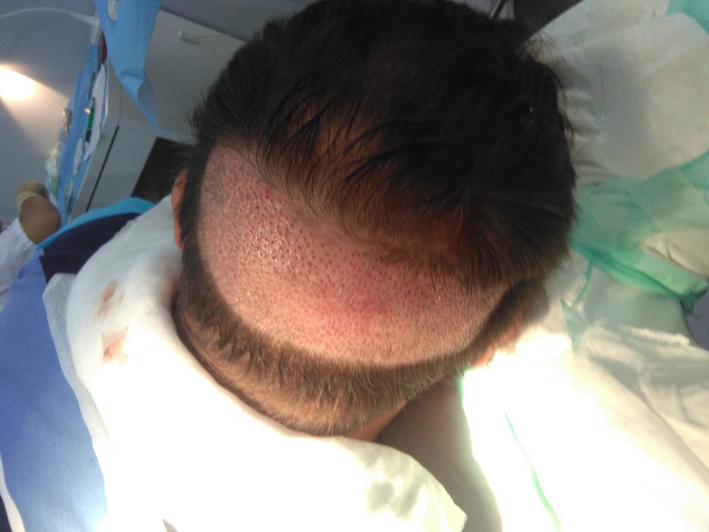 conoce el injerto capilar en turquía no recomendado