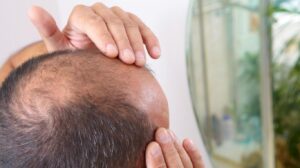 que-es-alopecia-en-el-cabello-que-es-la-enfermedad-de-la-alopecia