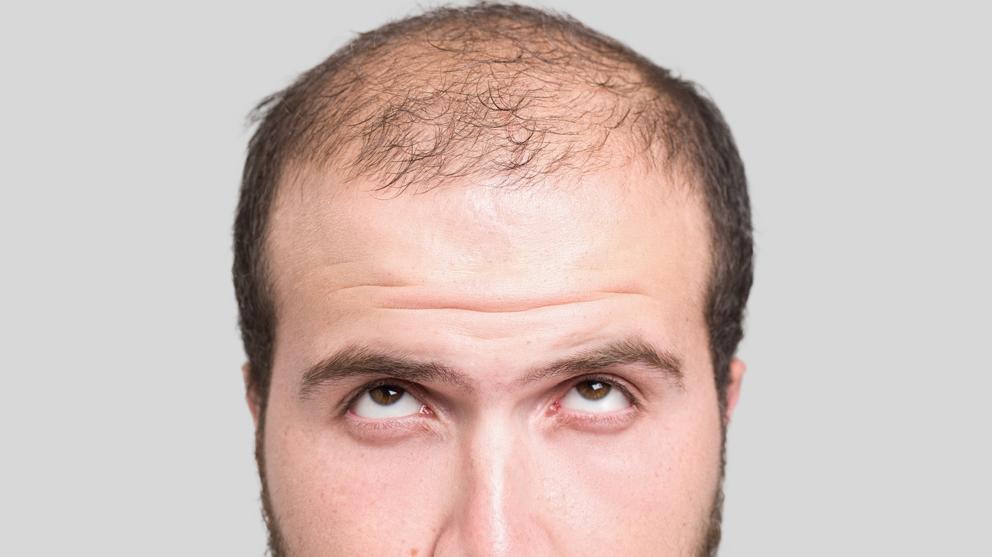 escala Hamilton – Norwood para medir la alopecia masculina