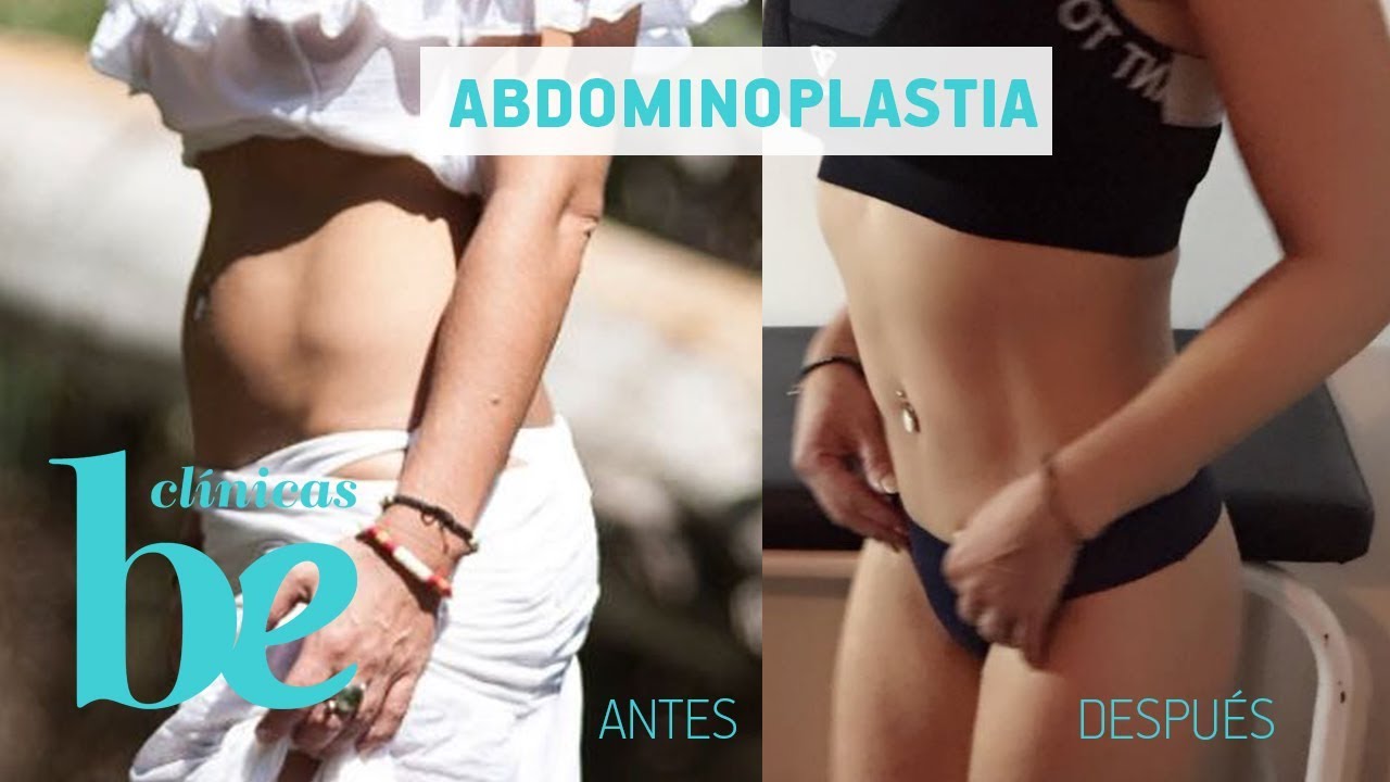abdominoplastia Clinicas Be