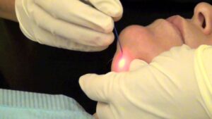 eliminación de papada con lipoláser