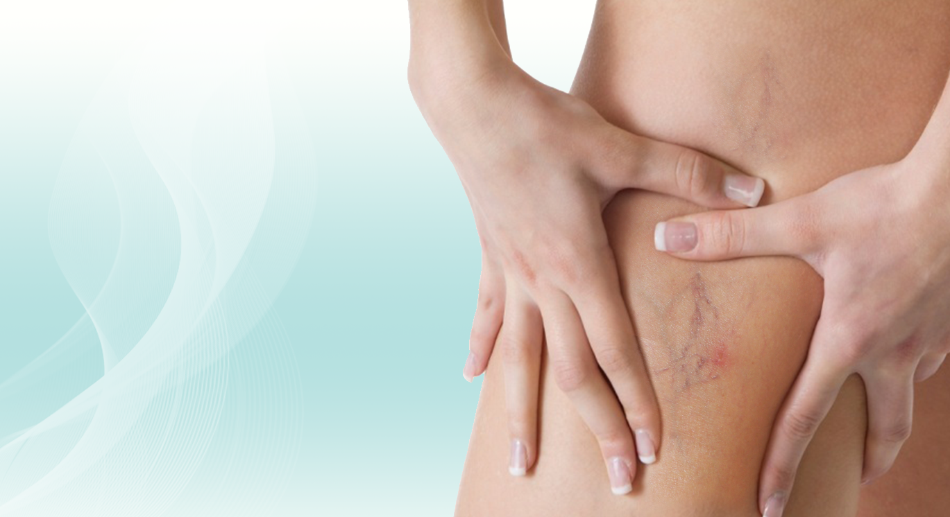 Tratamientos contra las varices