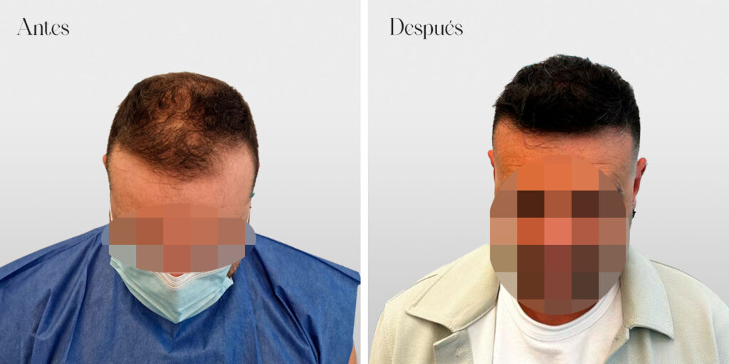 injerto-capilar-paciente-granada-y-malaga