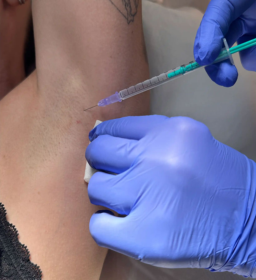 hiperhidrosis-clinicas-be-granada