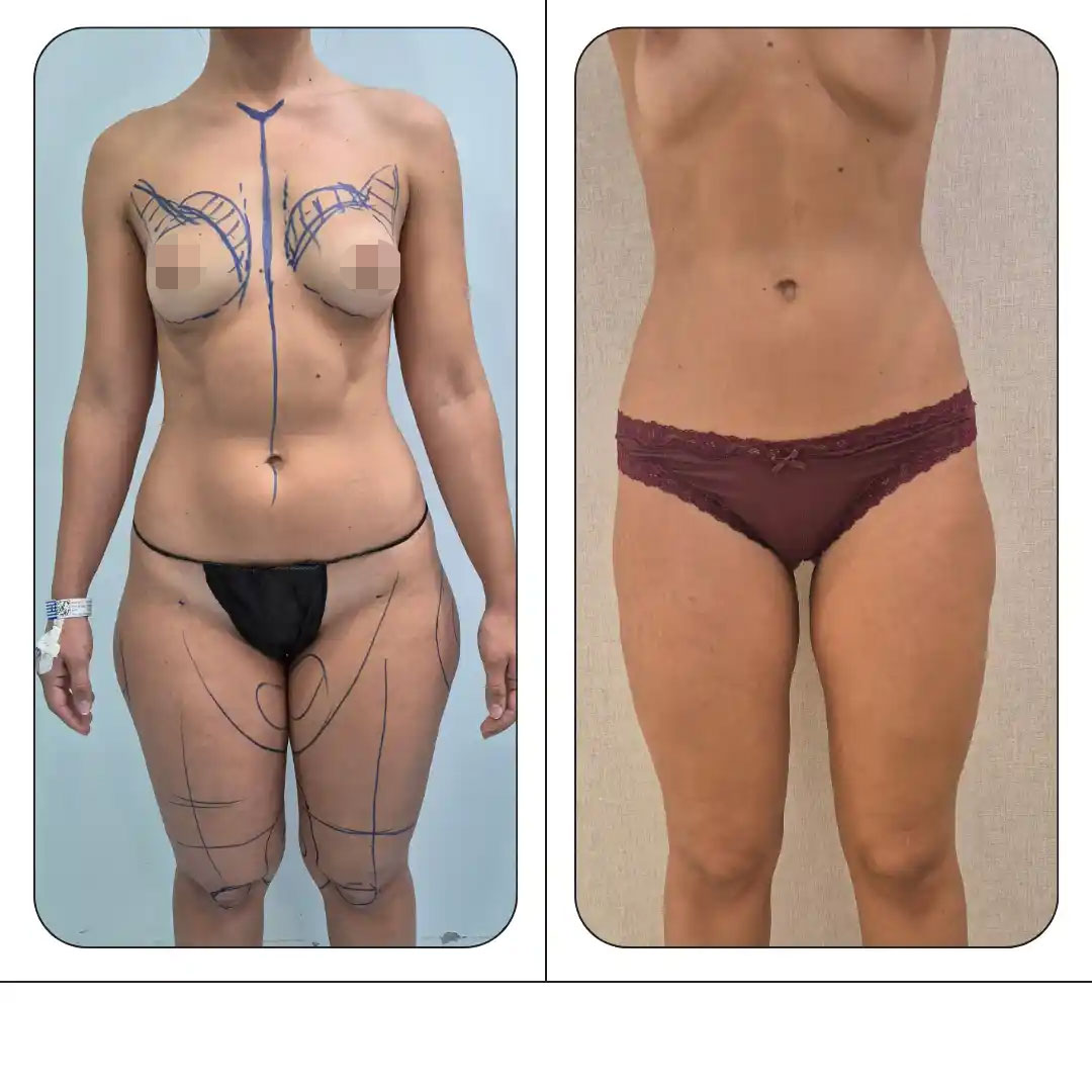 liposuccion-clinicas-be