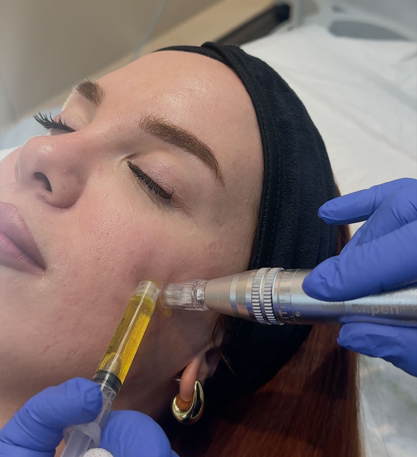 manchas-faciales-tratamiento-malaga