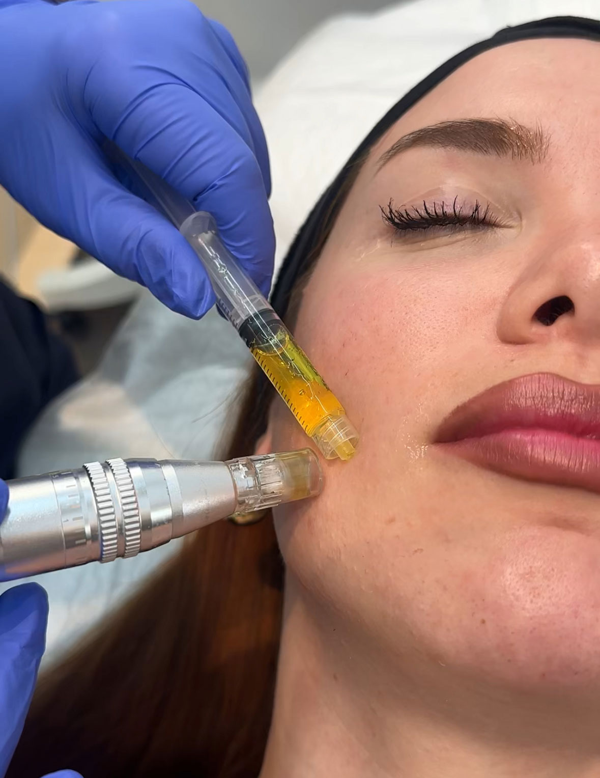 mesoterapia-facial-clinicas-be-granada