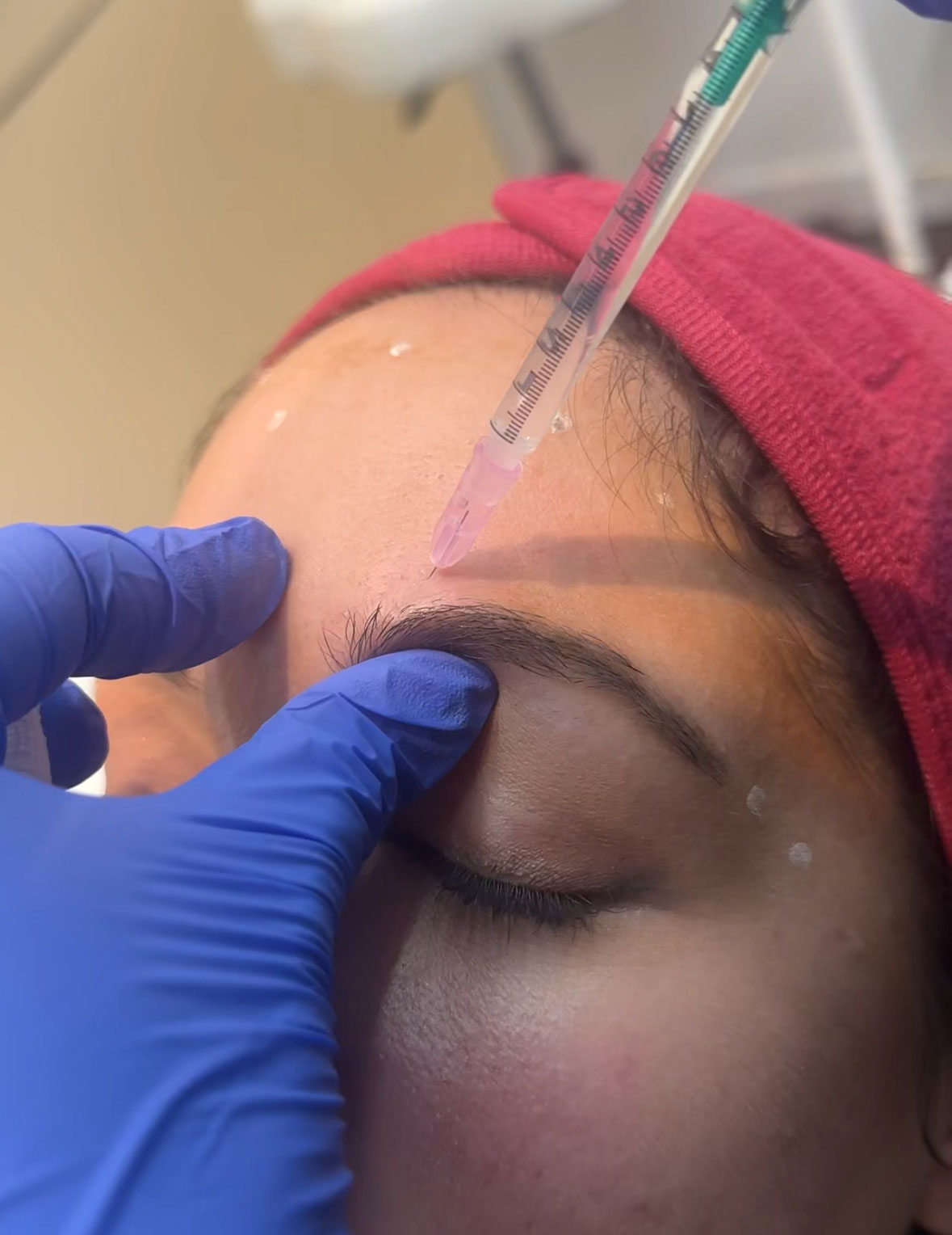 rellenos-faciales-clinica-estetica