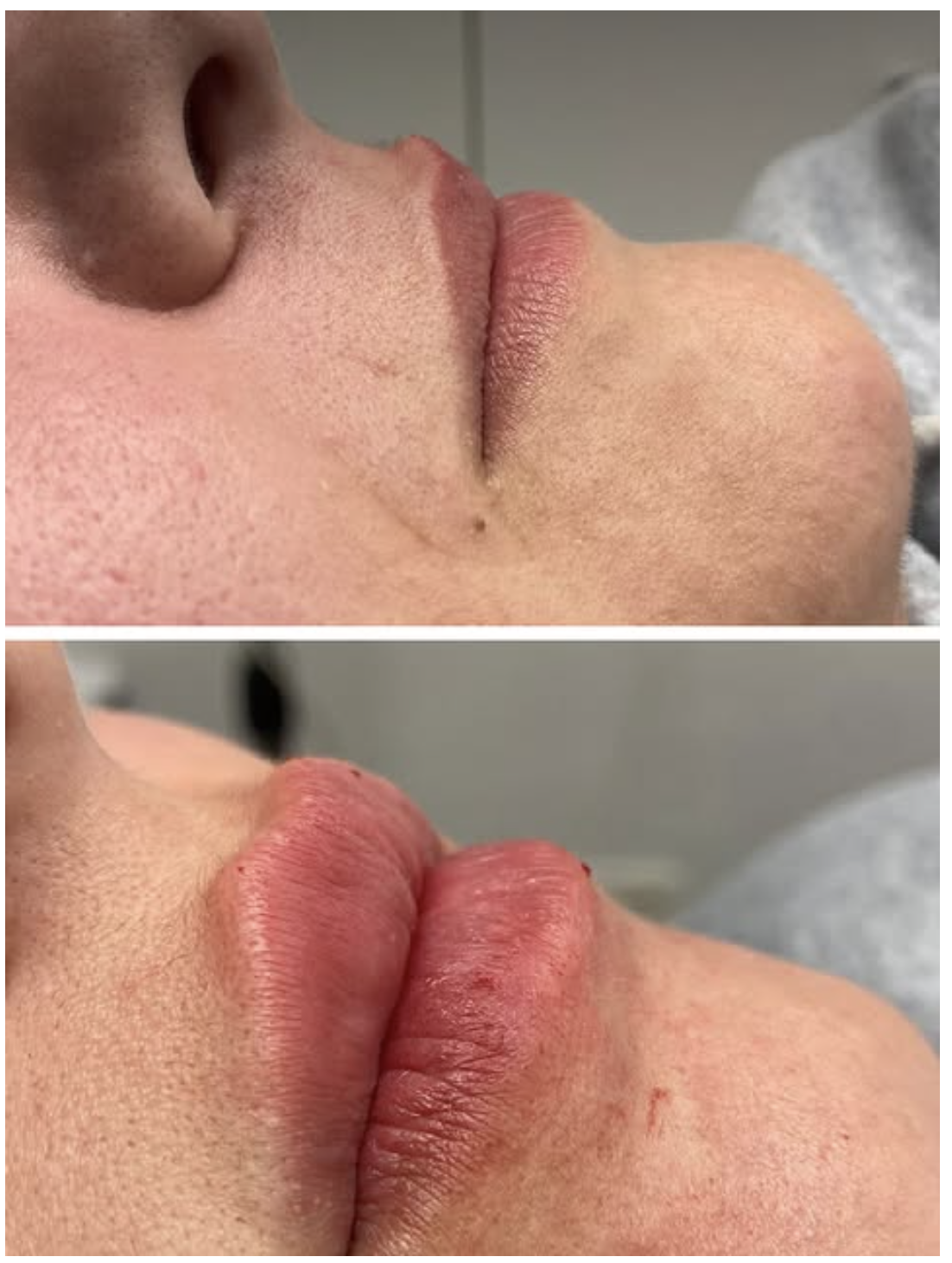 aumento de labios con acido hialuronico