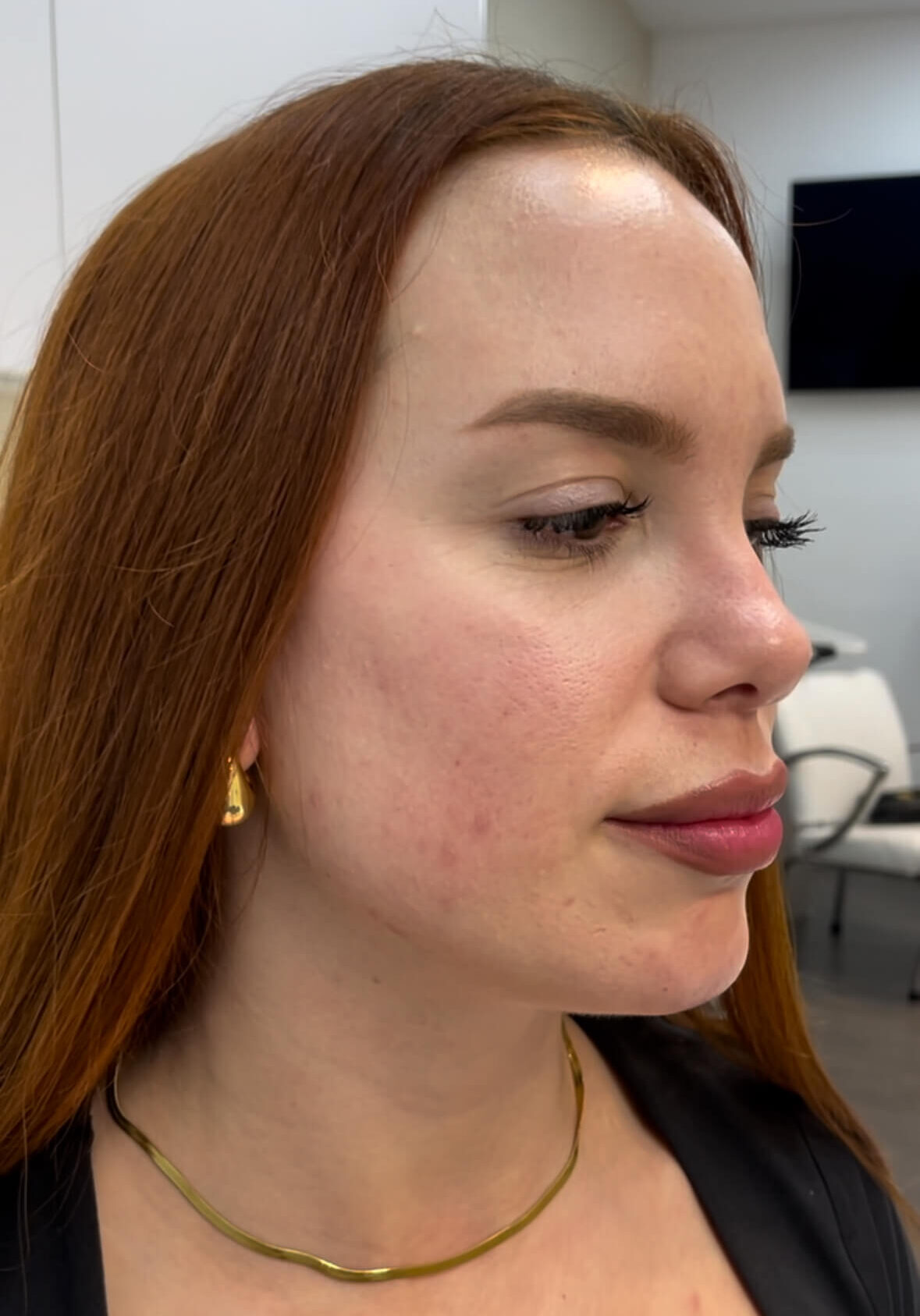 resultados aumento de labios en clinicas be