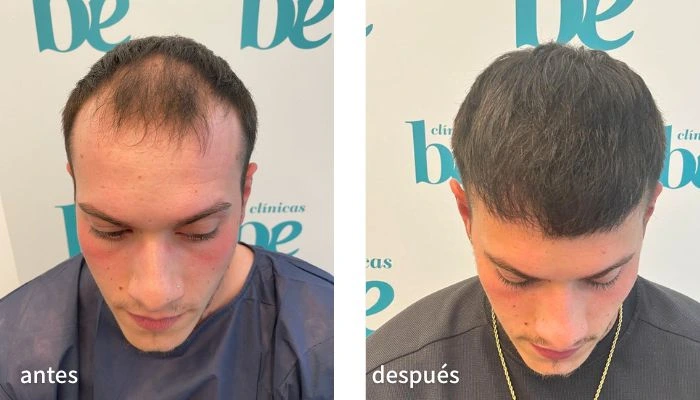 antes y después de un injerto capilar