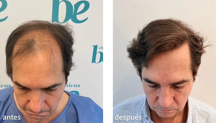 antes y después de un injerto capilar