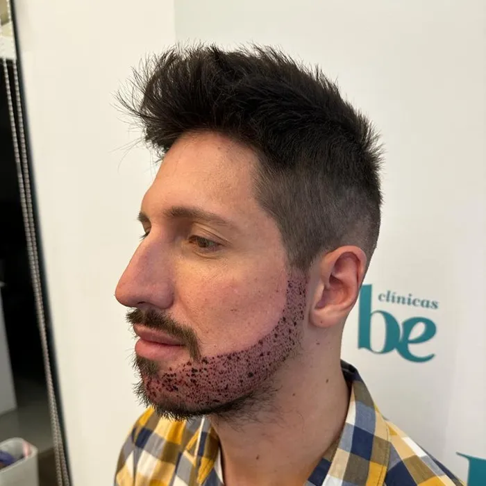 Un paciente con la barba injertada