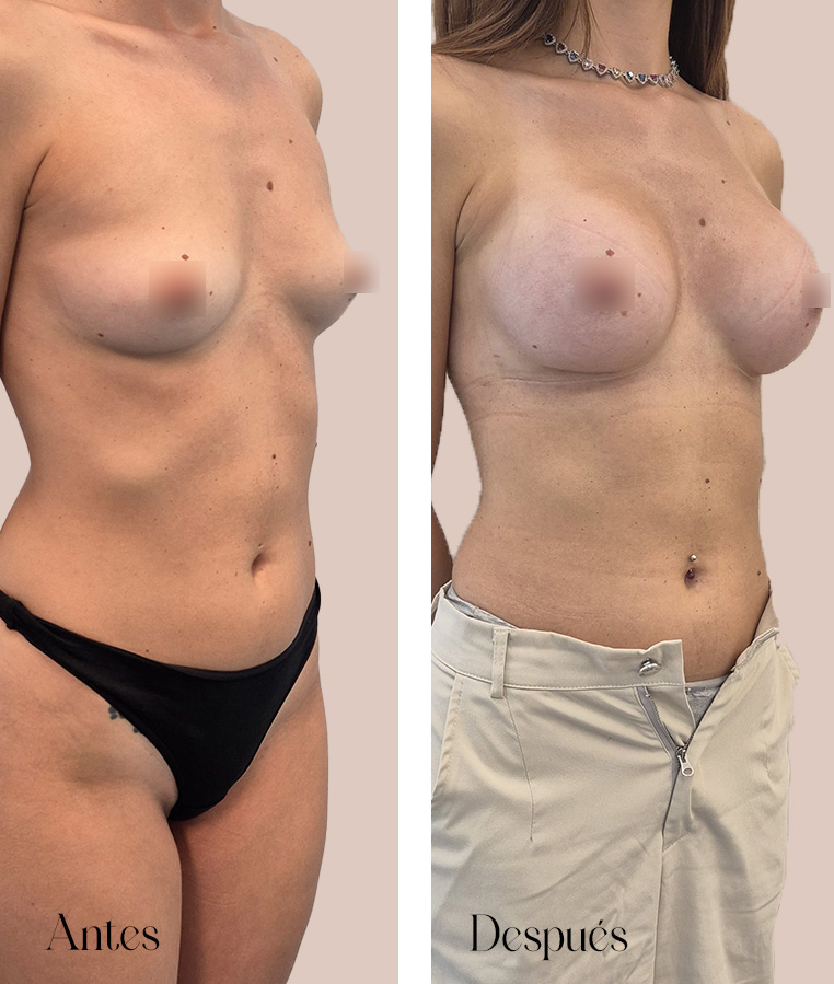 Antes y después de una paciente de aumento de pecho