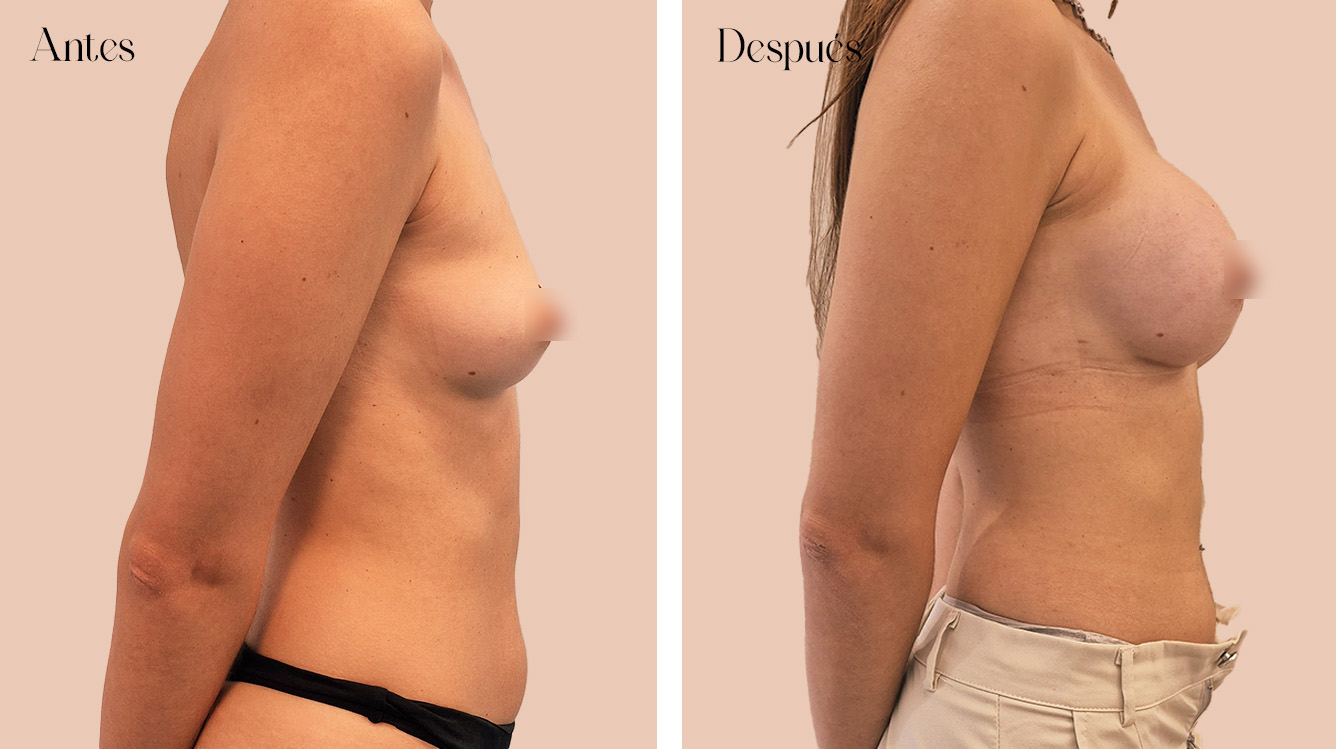 Antes y después de una paciente de aumento de pecho