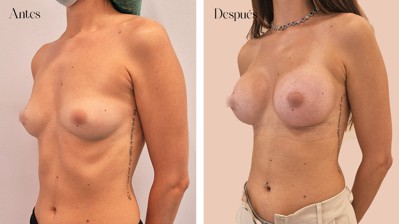 Antes y después de una paciente de aumento de pecho